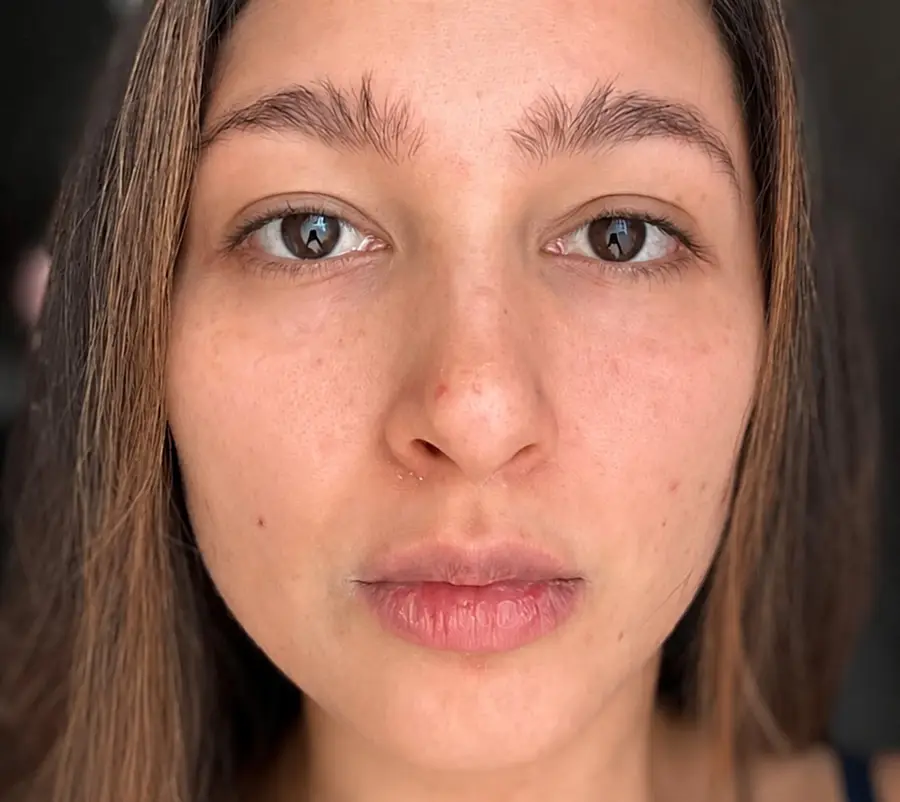 Rostro antes del protocolo de rejuvenecimiento