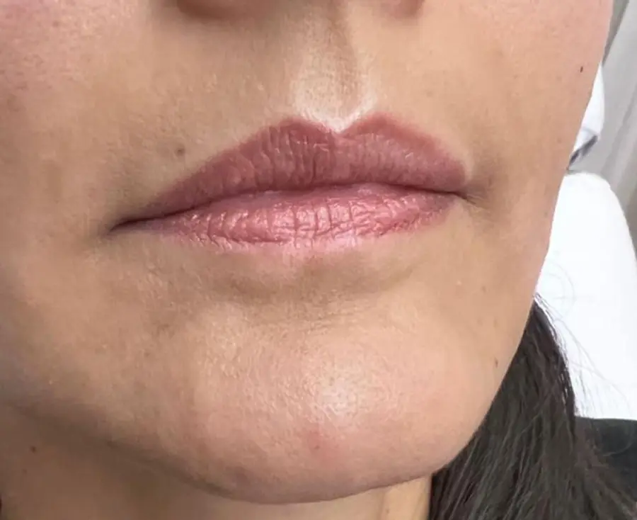 Labios antes del tratamiento con ácido hialurónico