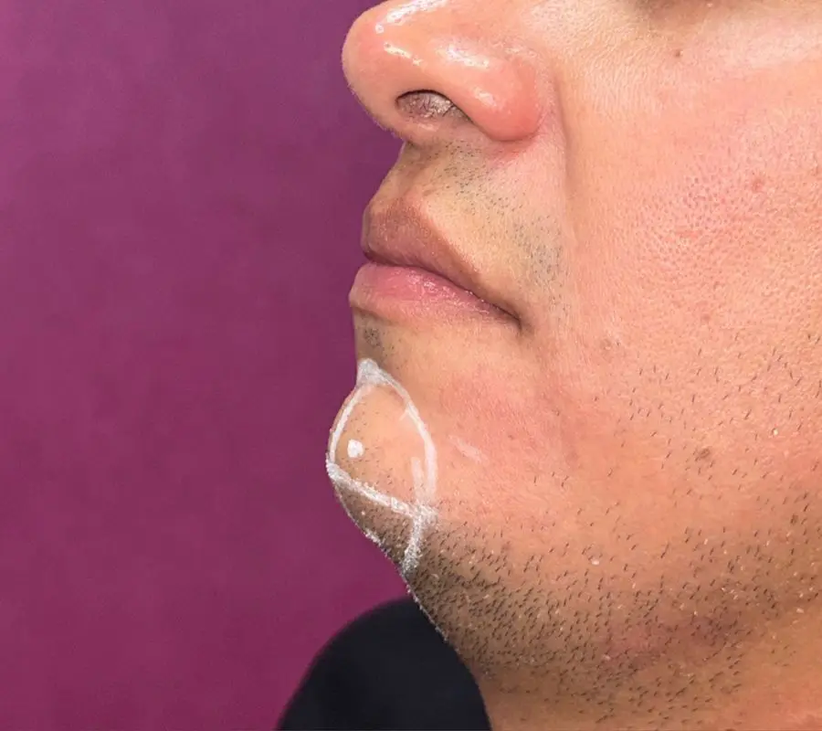 Perfil facial antes de definición mandibular